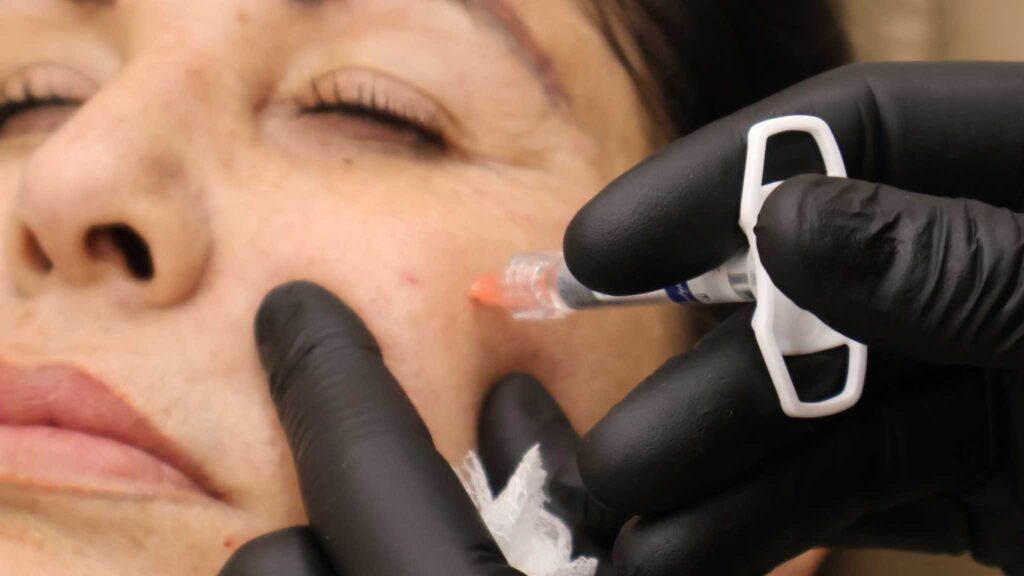 Dermal Filler Treatment in Oklahoma City, OK | ACE Med Spa