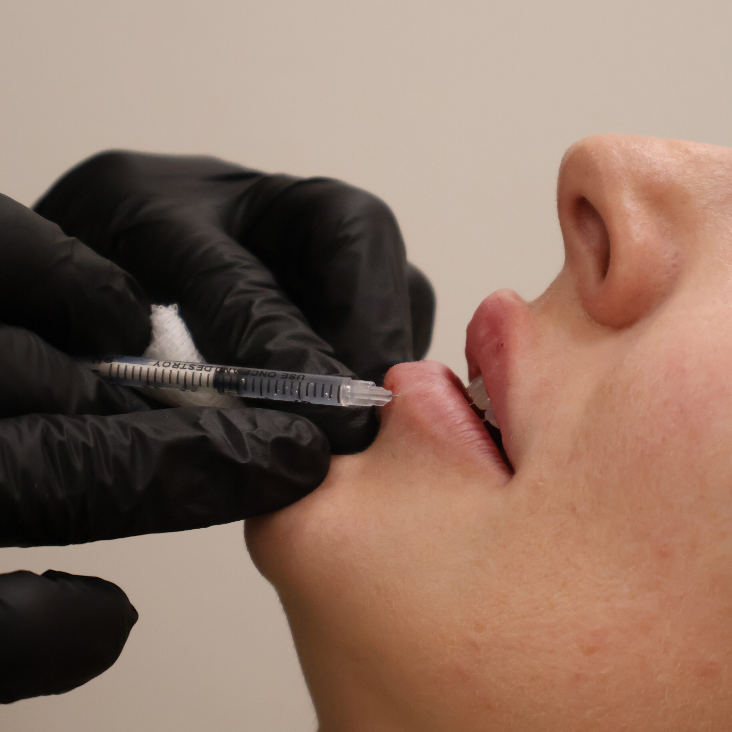 Side Effects Of Dermal Fillers | Aesthetic Center of Excellence in Oklahoma City, OK