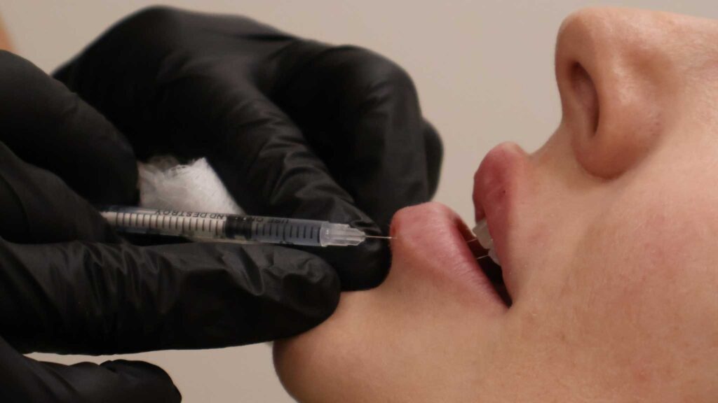 What Are The Side Effects Of Dermal Fillers? Lip Filler Treatment in Oklahoma City, OK | ACE Med Spa