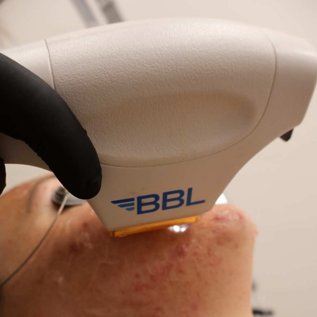 Photofacial Treatment | Aesthetic Center of Excellence in Oklahoma City, OK
