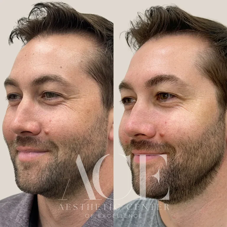 Before & After Gallery BBL Treatment Before and After | Aesthetic Center of Excellence in Oklahoma City, OK