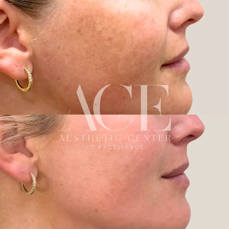 Before & After Gallery BBL and Moxi Laser Treatment Before And After | Aesthetic Center of Excellence in Oklahoma City, OK