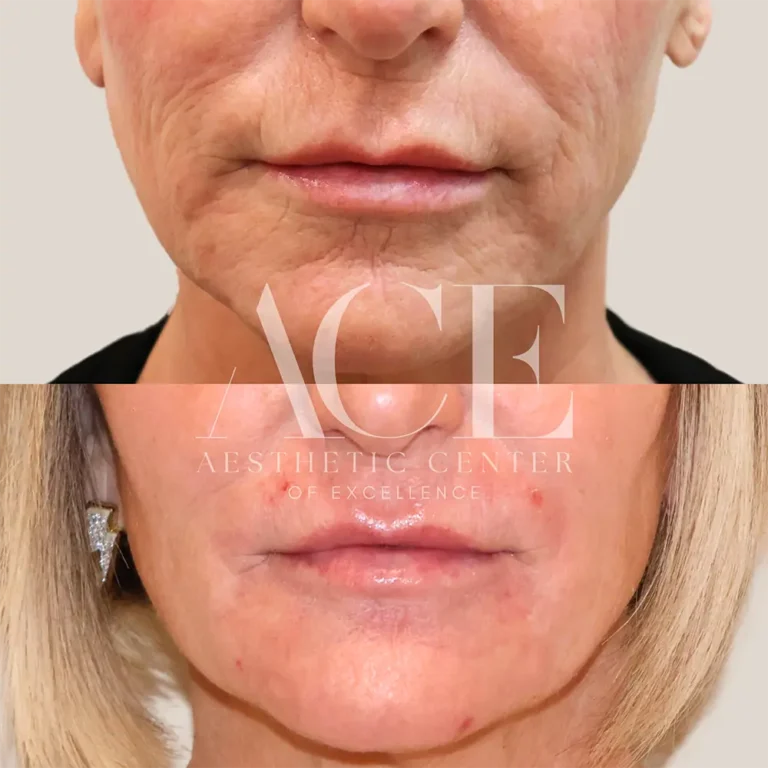 Before & After Gallery Before And After Lip Filler Treatment | Aesthetic Center of Excellence in Oklahoma City, OK