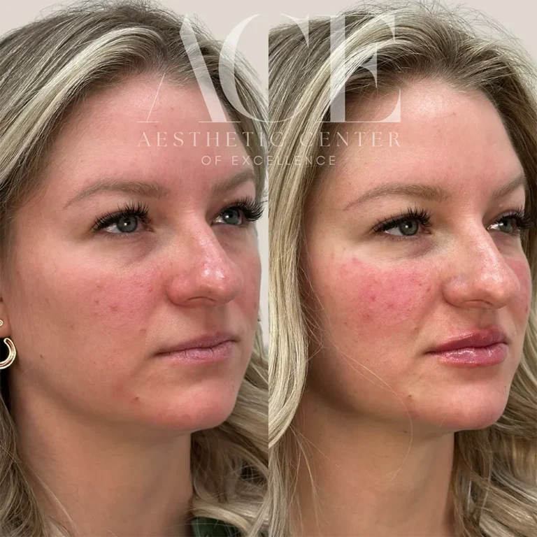 Before & After Gallery Filler and botox injectables combination treatment