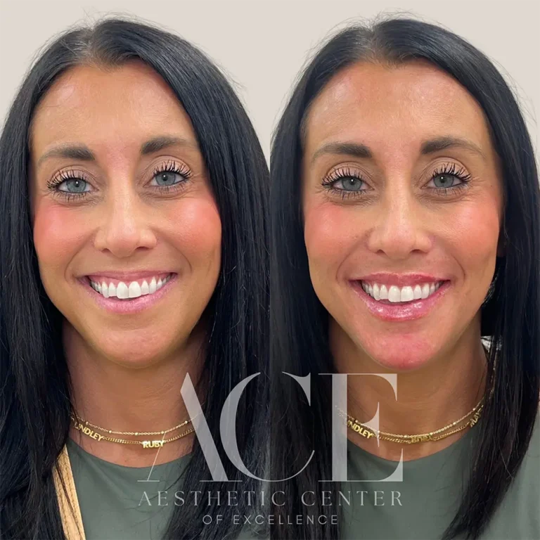 Before & After Gallery Filler and botox injectables combination treatment