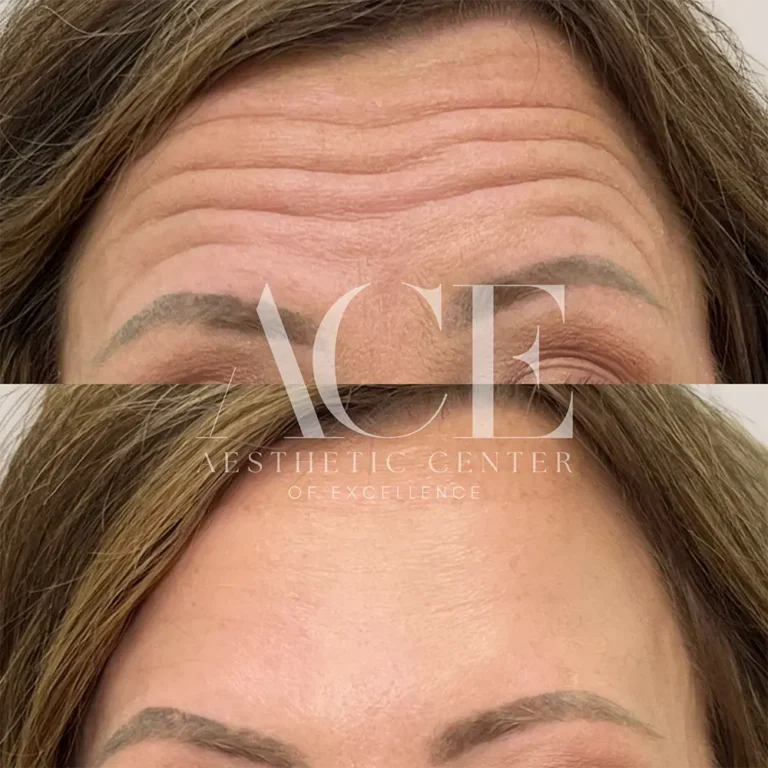 Before & After Gallery Forehead Botox Before and After | Aesthetic Center of Excellence in Oklahoma City, OK