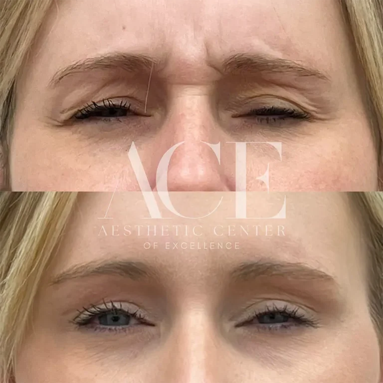 Before & After Gallery Frown Botox | Aesthetic Center of Excellence in Oklahoma City, OK