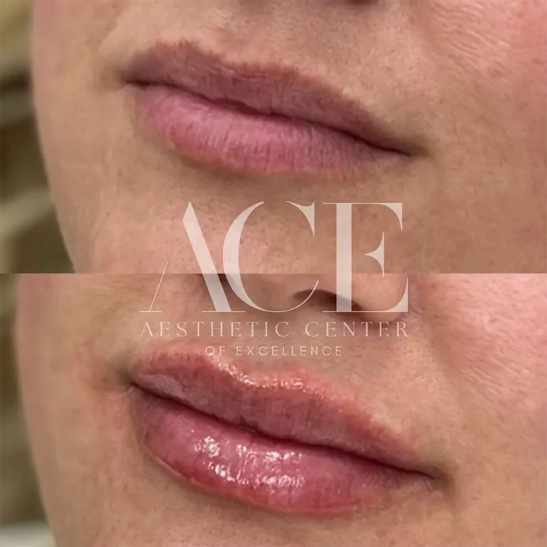Before & After Gallery Before And After Lip Filler Treatment | Aesthetic Center of Excellence in Oklahoma City, OK