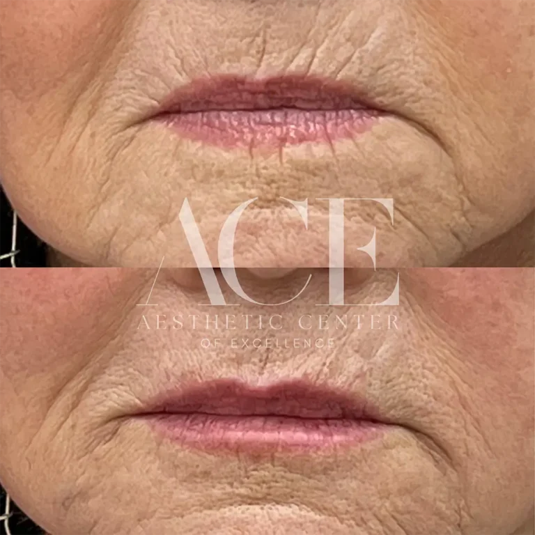 Before & After Gallery Before And After Lip Filler Treatment | Aesthetic Center of Excellence in Oklahoma City, OK