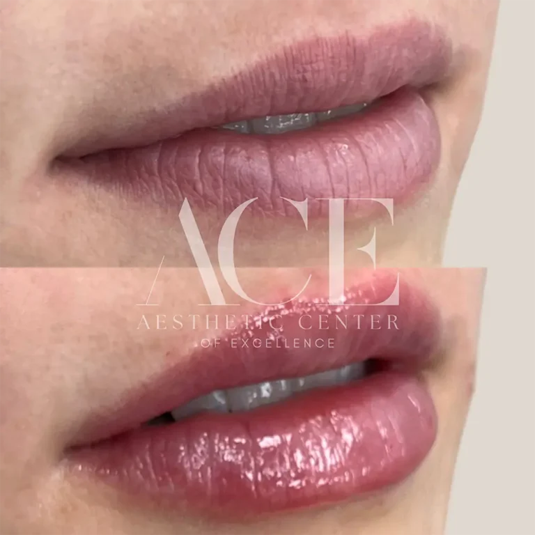 Before & After Gallery Before And After Lip Filler Treatment | Aesthetic Center of Excellence in Oklahoma City, OK