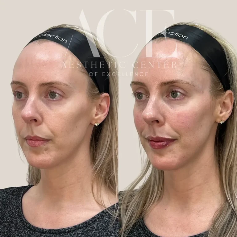 Before & After Gallery Filler and botox injectables combination treatment