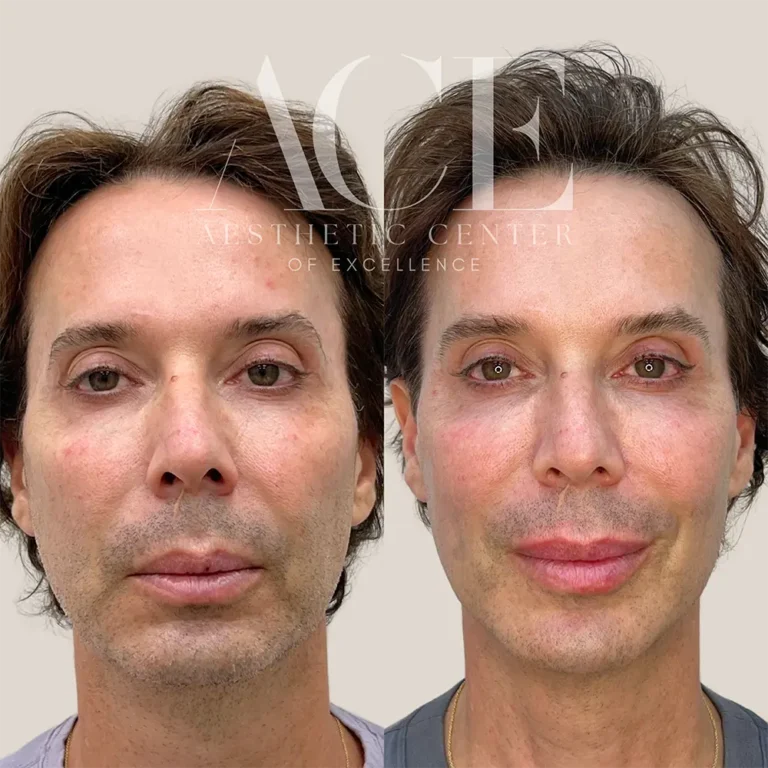 Before & After Gallery filler and botox combination treatment | Aesthetic Center of Excellence in Oklahoma City, OK