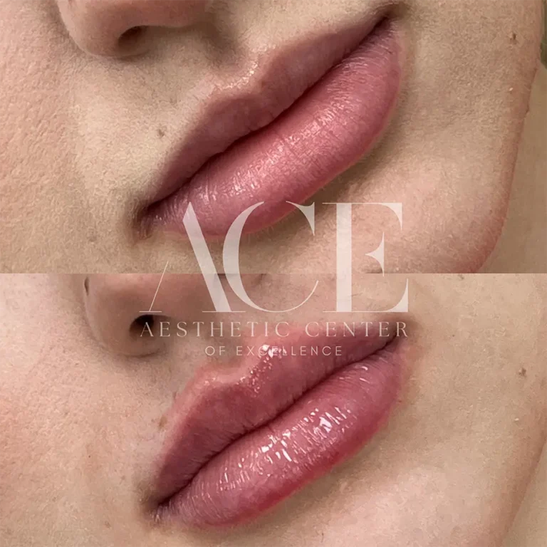 Before & After Gallery Before And After Lip Filler Treatment | Aesthetic Center of Excellence in Oklahoma City, OK