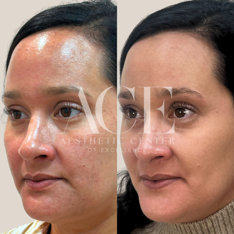 Before & After Gallery MOXI + ZO Pigment Control Protocol | Aesthetic Center of Excellence in Oklahoma City, OK