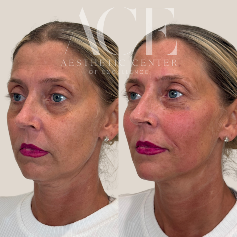 Before & After Gallery Before and After Full Face Rejuvenation Treatment | Aesthetic Center of Excellence in Oklahoma City, OK