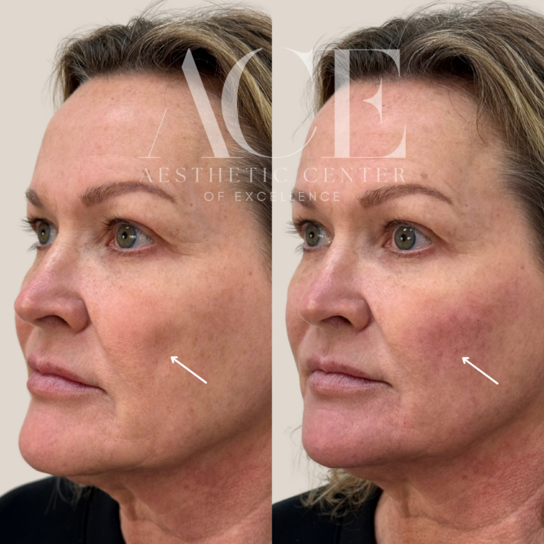 Before & After Gallery Cheek Dermal Filler | Aesthetic Center of Excellence in Oklahoma City, OK