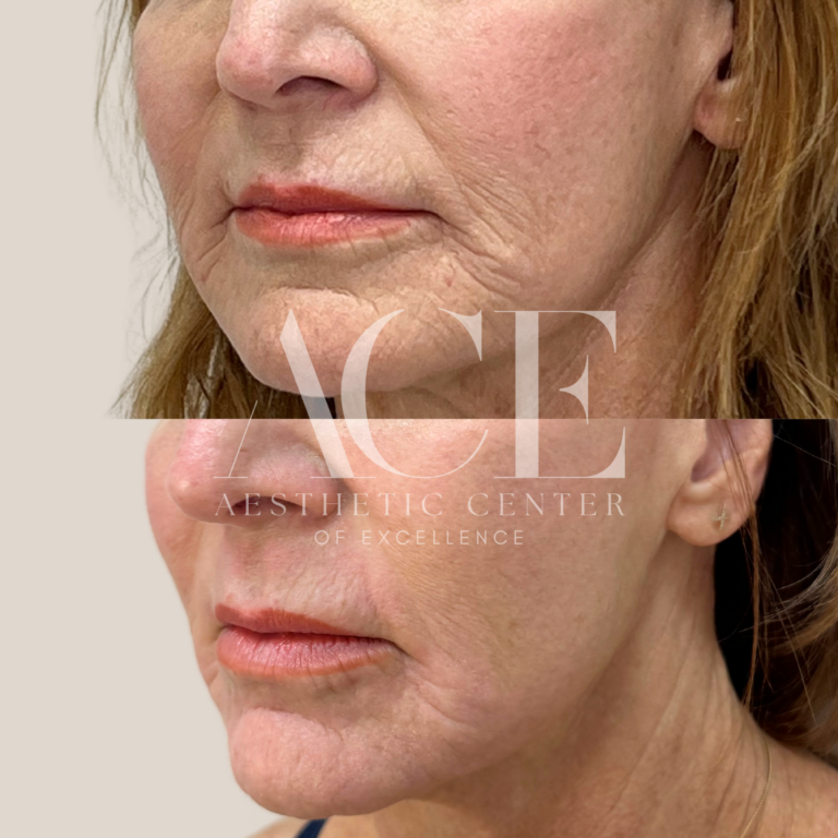 Before & After Gallery Before and After Halo Laser | Aesthetic Center of Excellence in Oklahoma City, OK