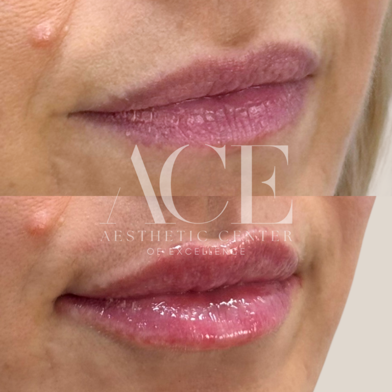 Before & After Gallery Lip Filler Treatment | Aesthetic Center of Excellence in Oklahoma City, OK