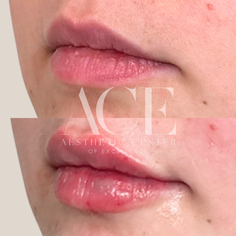 Before & After Gallery Lip Filler Treatment | Aesthetic Center of Excellence in Oklahoma City, OK