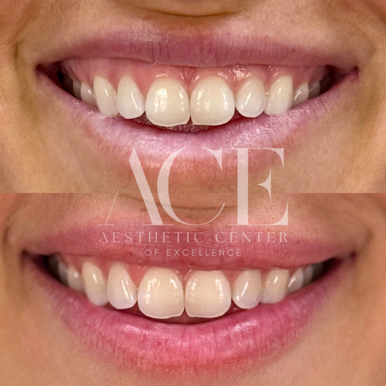 Before & After Gallery Lip Flip Botox Before and After Images in Oklahoma City, OK by Aesthetic Center of Excellence