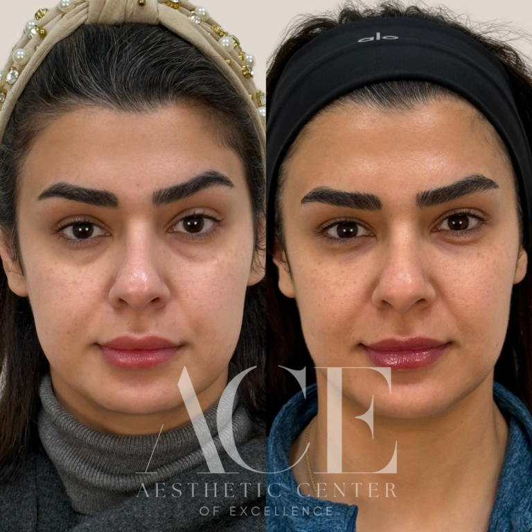 Before & After Gallery Tear Trough Medial Cheek Chin in Oklahoma City, OK by Aesthetic Center of Excellence