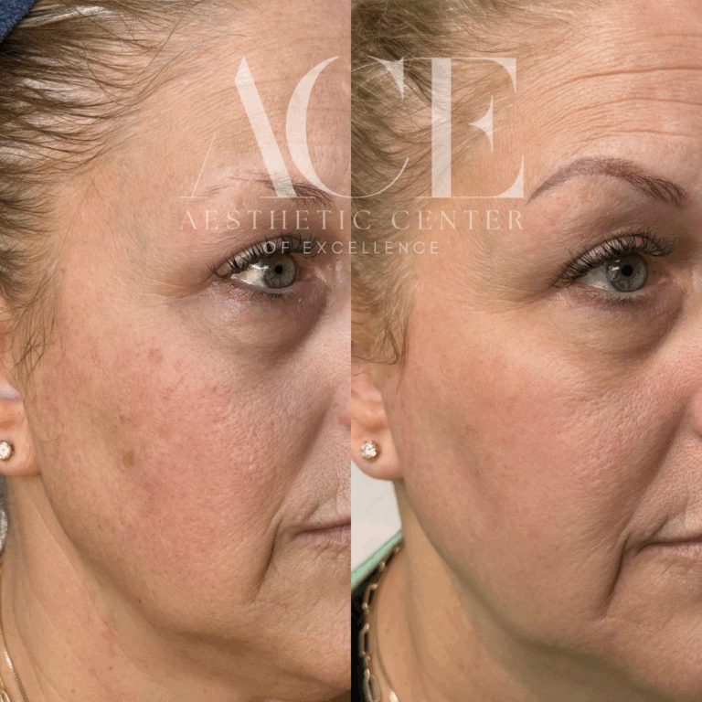 Before & After Gallery BBL Moxi Before and After Images in Oklahoma City, OK | ACE Med Spa