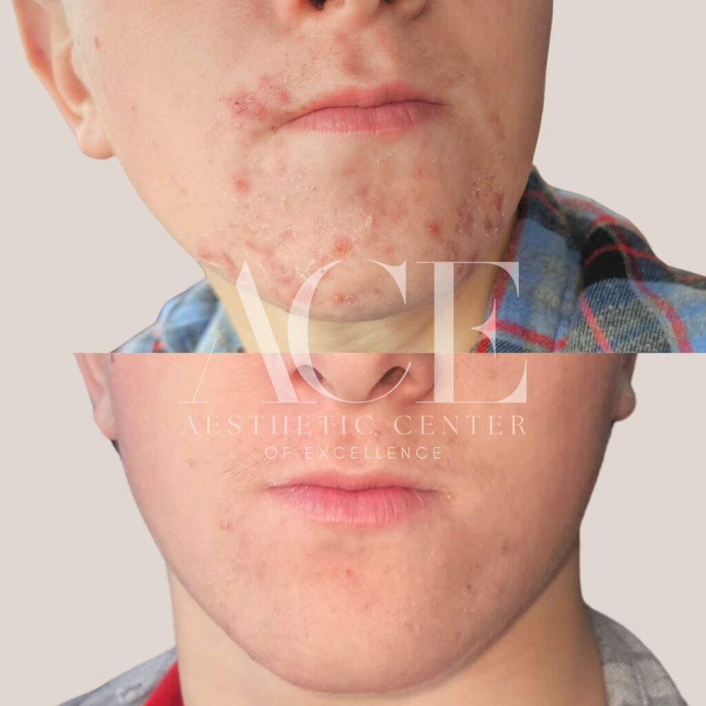Before and After Images For Medical Grade Skincare in Oklahoma City, OK | ACE Med Spa