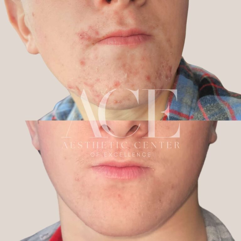 Before & After Gallery Before and After Images For Medical Grade Skincare in Oklahoma City, OK | ACE Med Spa