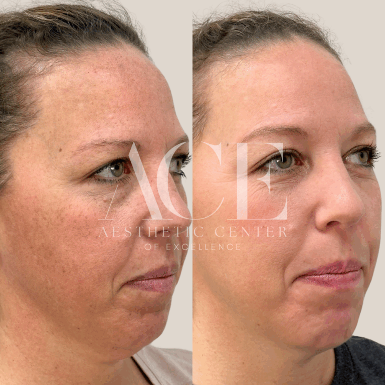 Before & After Gallery ZO Skincare Hydroquinone in Oklahoma City, OK | ACE Med Spa