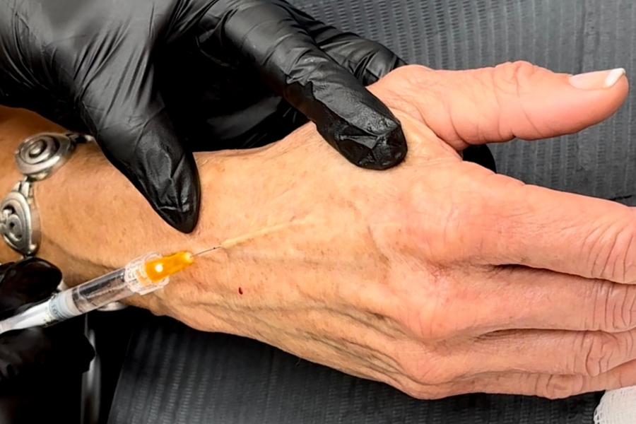 Dermal Filler Treatment in Oklahoma City, OK
