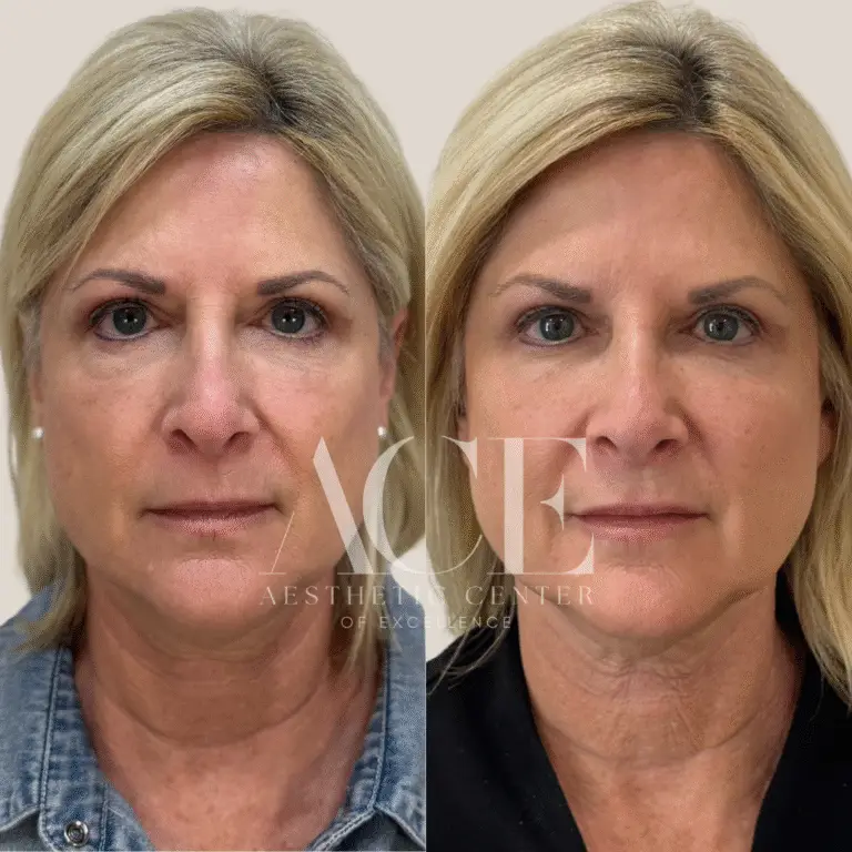 Before & After Gallery ace med spa ariessence before and after