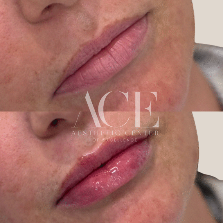 Before & After Gallery Lip Filler before and after at ace med spa