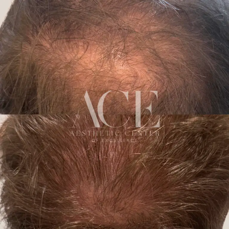 Before & After Gallery hair restoration at ace med spa