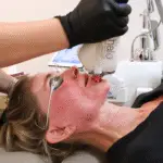 halo laser treatment in oklahoma city at aesthetic center of excellence