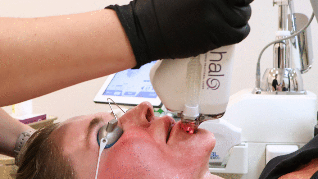 HALO Laser: Why It’s Called the “Game-Changer” in Skin Resurfacing