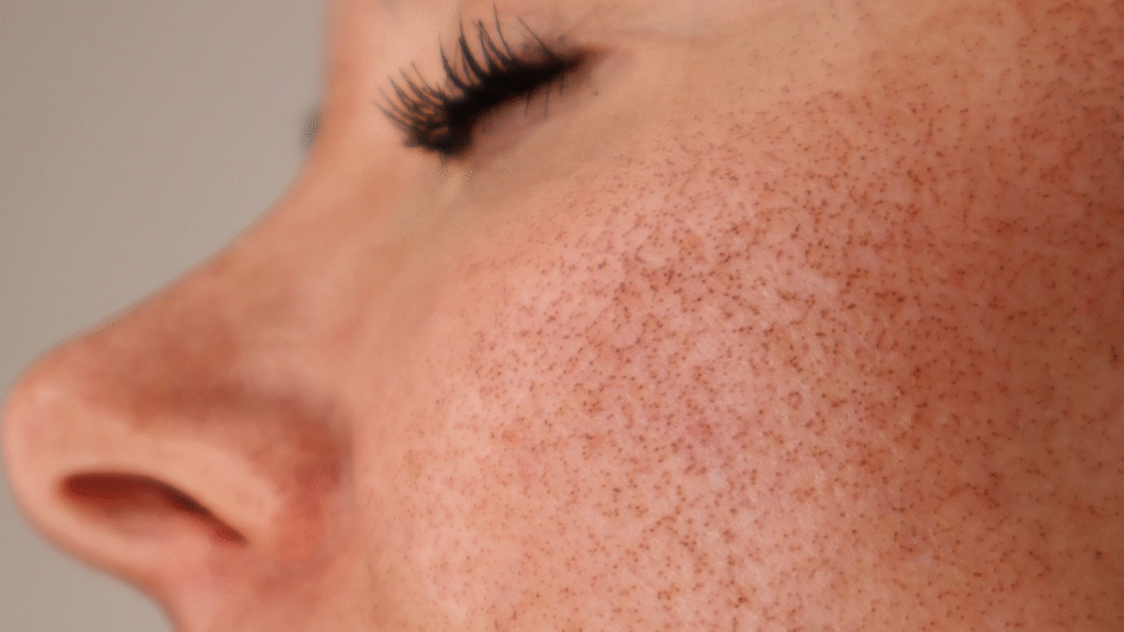 Glow with MOXI: Results You Can Expect After Treatment Glow with MOXI: Results You Can Expect After Treatment